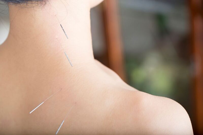 乾式針治療 vs 鍼治療